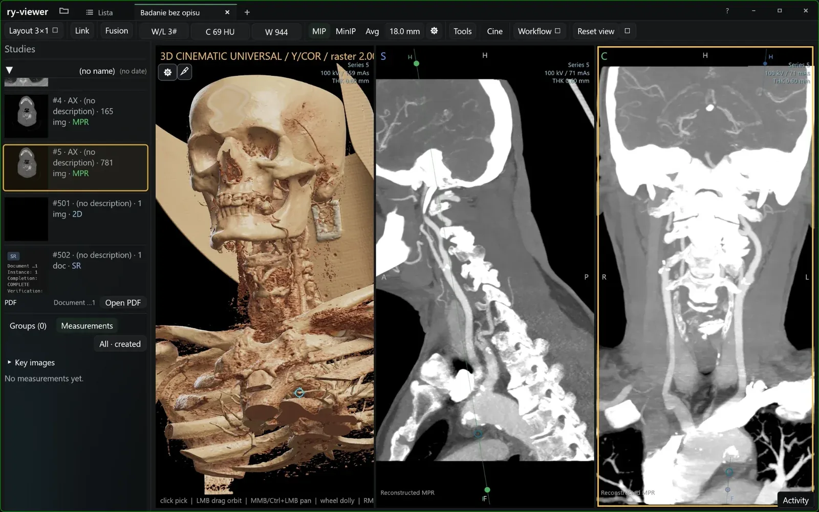 ry-viewer: rendering kinowy 3D głowy i szyi obok rekonstrukcji strzałkowej i czołowej angio-TK, lista serii po lewej.